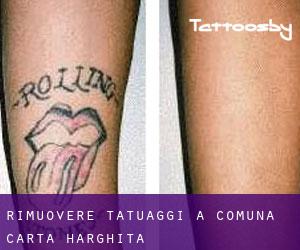 Rimuovere Tatuaggi a Comuna Cârţa (Harghita)