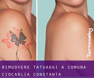 Rimuovere Tatuaggi a Comuna Ciocârlia (Constanţa)