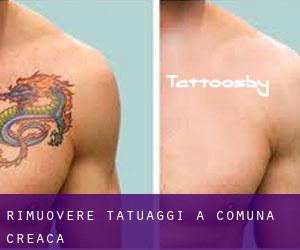 Rimuovere Tatuaggi a Comuna Creaca