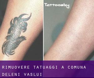 Rimuovere Tatuaggi a Comuna Deleni (Vaslui)