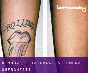 Rimuovere Tatuaggi a Comuna Ghergheşti