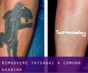 Rimuovere Tatuaggi a Comuna Grădina