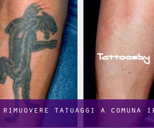 Rimuovere Tatuaggi a Comuna Ip