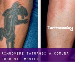 Rimuovere Tatuaggi a Comuna Logreşti-Moşteni