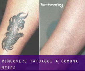 Rimuovere Tatuaggi a Comuna Meteş