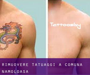 Rimuovere Tatuaggi a Comuna Nămoloasa