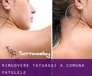 Rimuovere Tatuaggi a Comuna Pătulele