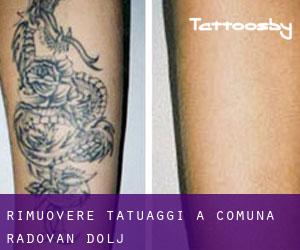 Rimuovere Tatuaggi a Comuna Radovan (Dolj)