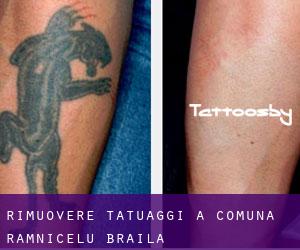 Rimuovere Tatuaggi a Comuna Râmnicelu (Brăila)