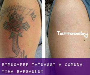 Rimuovere Tatuaggi a Comuna Tiha Bârgăului