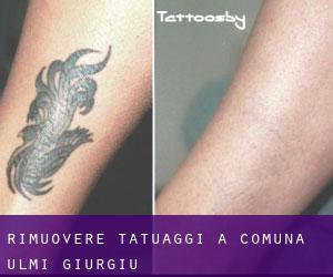 Rimuovere Tatuaggi a Comuna Ulmi (Giurgiu)