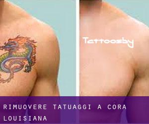 Rimuovere Tatuaggi a Cora (Louisiana)