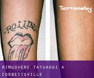 Rimuovere Tatuaggi a Corbettsville