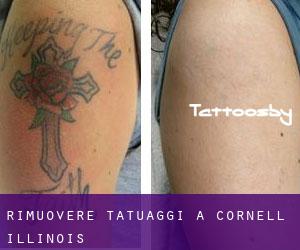 Rimuovere Tatuaggi a Cornell (Illinois)