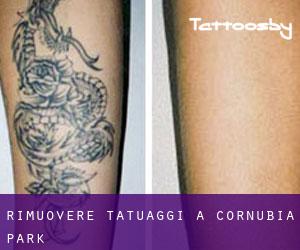 Rimuovere Tatuaggi a Cornubia Park