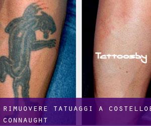 Rimuovere Tatuaggi a Costelloe (Connaught)