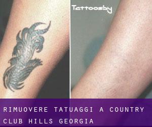 Rimuovere Tatuaggi a Country Club Hills (Georgia)