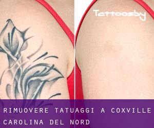 Rimuovere Tatuaggi a Coxville (Carolina del Nord)