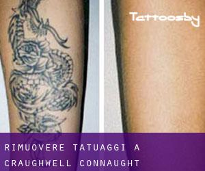 Rimuovere Tatuaggi a Craughwell (Connaught)