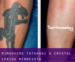 Rimuovere Tatuaggi a Crystal Spring (Minnesota)