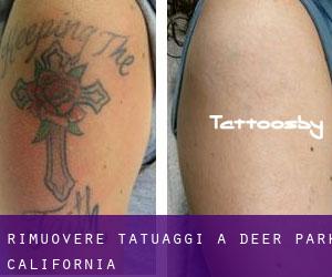 Rimuovere Tatuaggi a Deer Park (California)