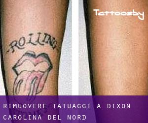 Rimuovere Tatuaggi a Dixon (Carolina del Nord)