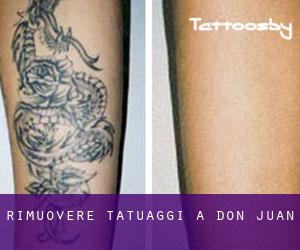 Rimuovere Tatuaggi a Don Juan