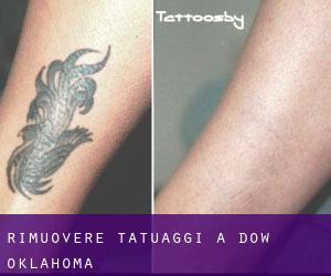 Rimuovere Tatuaggi a Dow (Oklahoma)