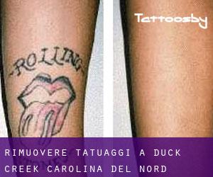 Rimuovere Tatuaggi a Duck Creek (Carolina del Nord)