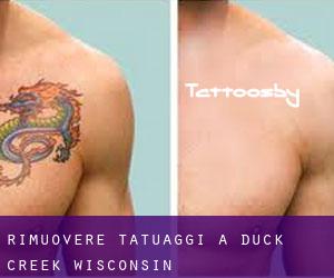 Rimuovere Tatuaggi a Duck Creek (Wisconsin)