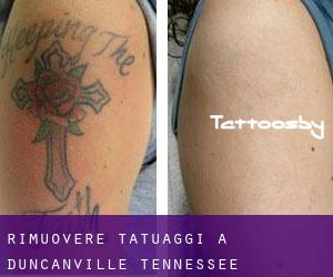 Rimuovere Tatuaggi a Duncanville (Tennessee)