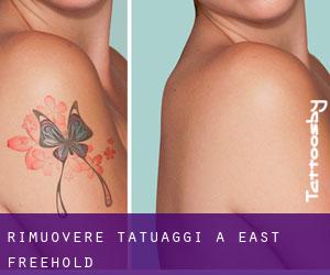 Rimuovere Tatuaggi a East Freehold