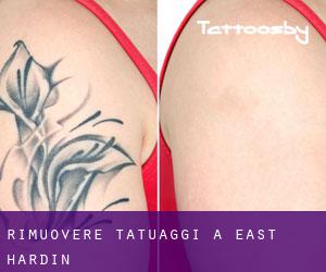 Rimuovere Tatuaggi a East Hardin