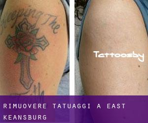 Rimuovere Tatuaggi a East Keansburg