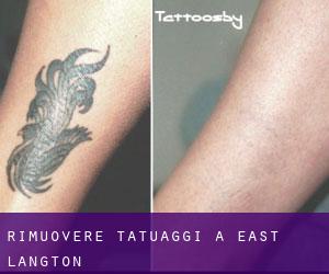 Rimuovere Tatuaggi a East Langton