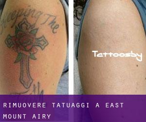 Rimuovere Tatuaggi a East Mount Airy