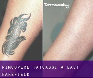 Rimuovere Tatuaggi a East Wakefield