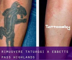 Rimuovere Tatuaggi a Ebbetts Pass Highlands