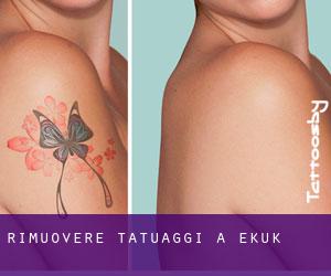 Rimuovere Tatuaggi a Ekuk
