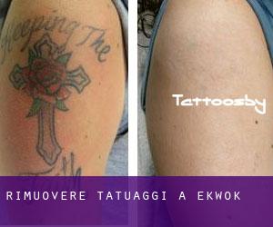 Rimuovere Tatuaggi a Ekwok