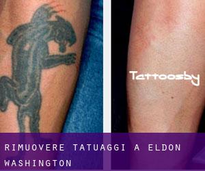 Rimuovere Tatuaggi a Eldon (Washington)