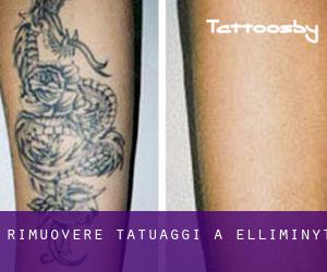 Rimuovere Tatuaggi a Elliminyt