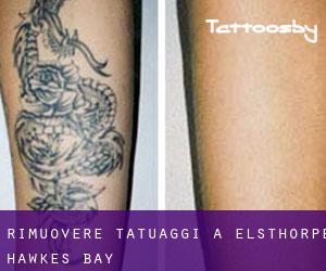 Rimuovere Tatuaggi a Elsthorpe (Hawke's Bay)