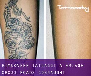 Rimuovere Tatuaggi a Emlagh Cross Roads (Connaught)