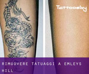 Rimuovere Tatuaggi a Emleys Hill