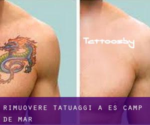 Rimuovere Tatuaggi a es Camp de Mar