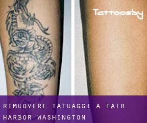 Rimuovere Tatuaggi a Fair Harbor (Washington)