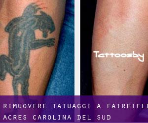 Rimuovere Tatuaggi a Fairfield Acres (Carolina del Sud)