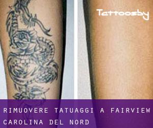 Rimuovere Tatuaggi a Fairview (Carolina del Nord)