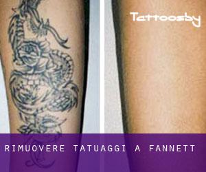 Rimuovere Tatuaggi a Fannett